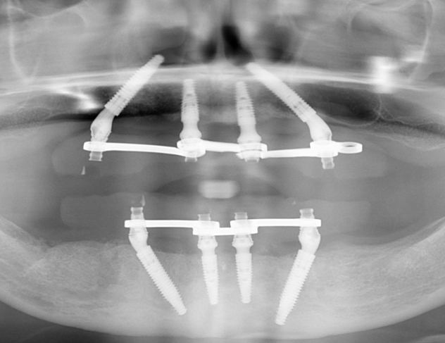 Pantomogram - wszczepienie implantów pod stały most, protezę