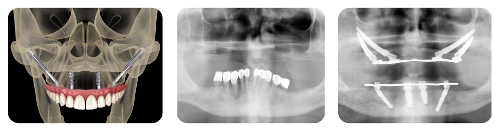 implanty jażmowe w metodzie Nowe Zęby w Jeden Dzień